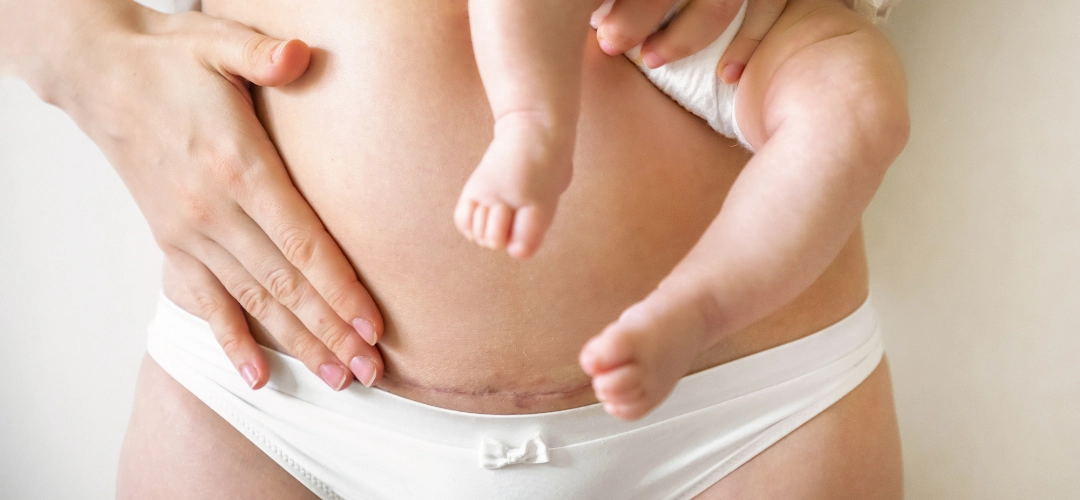 C-Section Recovery: 10 Things You Can Do to Promote Healing